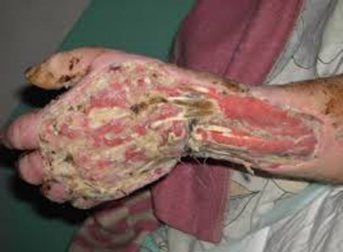 krokodil_drug_03